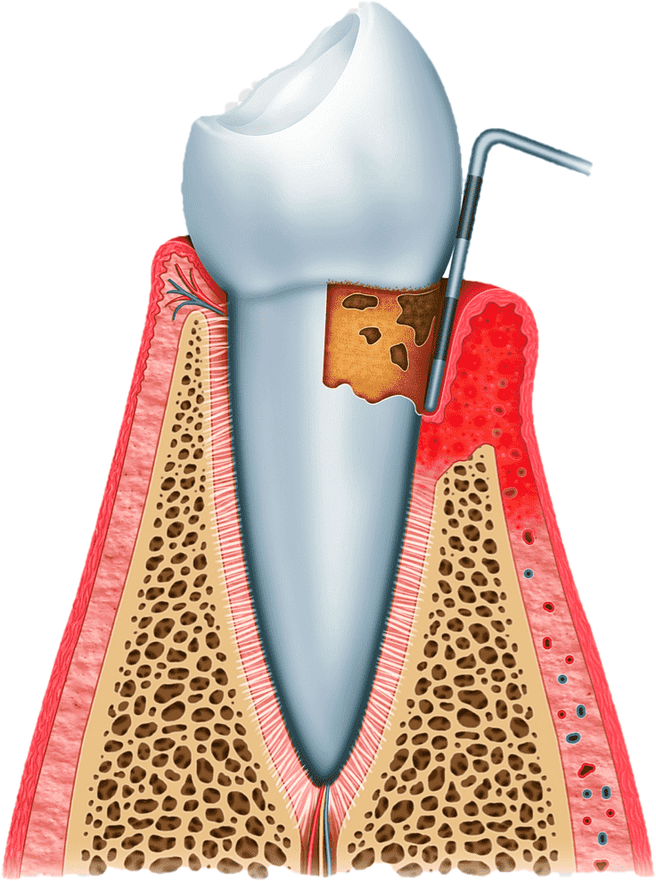 Гигиеническая чистка зубов Воронеж