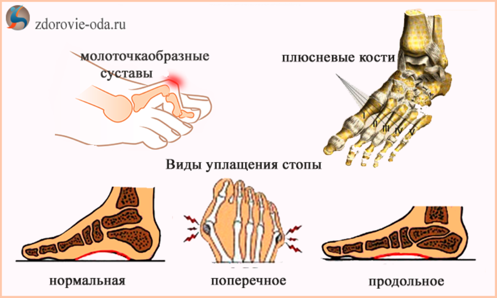 Продольное плоскостопие ног. Плоскостопие поперечного свода стопы. Продольно-поперечное плоскостопие и вальгус 3 степени. Продольное плоскостопие деформация стопы. Тип свода стопы.