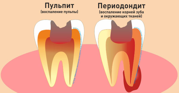 Какими лекарствами лечить пульпит. Прямое и непрямое покрытие пульпы зуба. 4 канальный пульпит зуба. Лечение пульпита лекарством. Биологический метод лечения пульпита.